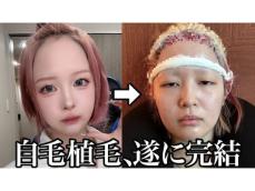 「大成功すぎて毎日幸せ」登録者数100万人超えYouTuber、“広すぎるデコ”の整形を告白「天使すぎ」