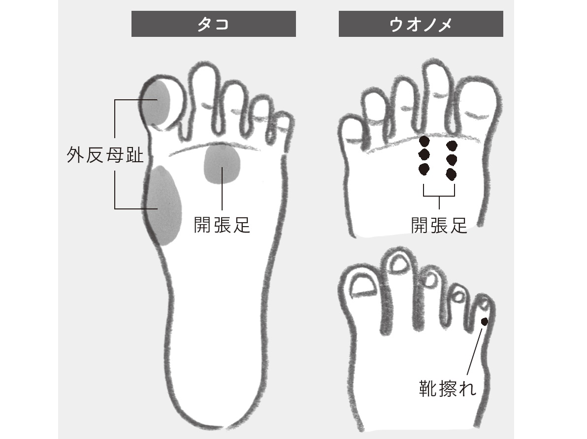 開張足、外反母趾、ウオノメ・タコ…足トラブルの予防＆ケア法