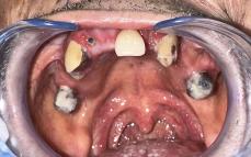 「要介護者の口内はまるで荒野」「細菌数は排水口・肛門レベル」訪問歯科医が解説する“戦略的抜歯のすすめ”