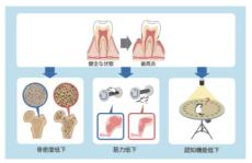 歯周炎による炎症は老化を促進して各種臓器の障害を招く