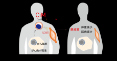 進行がんでみられる"痩せ"を引き起こす新たな免疫細胞を発見