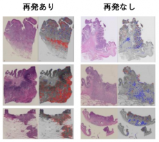 【東京医科大学】大腸がんの予後とゲノム異常を予測する人工知能（AI）の開発　～新たなAIモデルによる個別化医療を目指して～