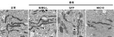 神経-肝型ミトコンドリアDNA枯渇症の新規原因遺伝子を特定　～世界初の症例を報告～