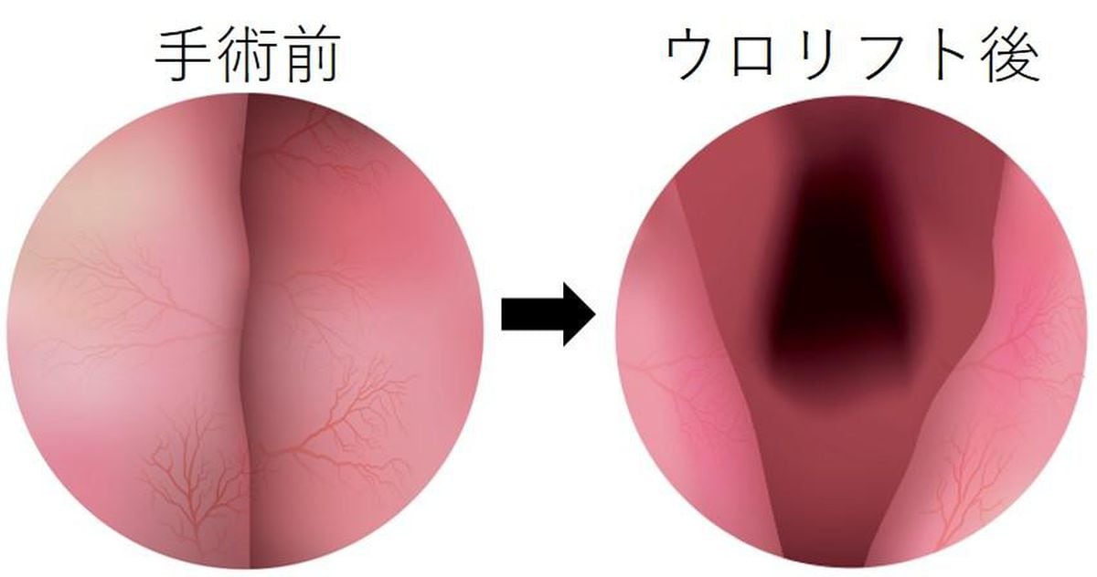 前立腺肥大症・最新治療　最新の手術法「ＷＡＶＥ」と「ウロリフト」　治療で〝切る、焼く〟ことに抵抗感を持つ人へ　いずれも保険ＯＫ