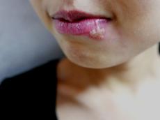 日本人の6割が保有…しつこい口唇ヘルペスは新たな「PIT療法」で撃退できる