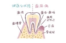 女性ホルモンと歯の関係。｜働く女性のための転機の準備