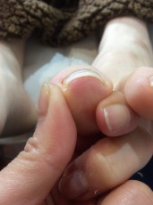 「巻き爪を改善させる方法」でネイルの痛みから解放!