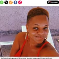 【海外発！Breaking News】「巨大乳房症」の37歳女性、縮小手術で自信を取り戻す「人生はまだ始まったばかり」（英）
