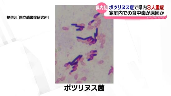富山県内で初めて感染確認　ボツリヌス症で３人重症