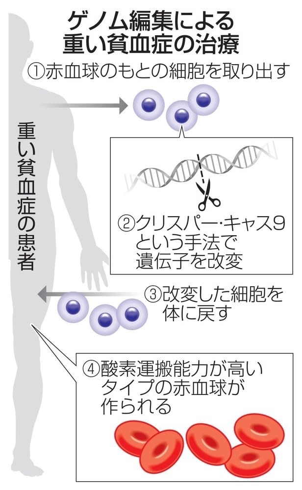 ゲノム編集治療、承認広がる　重い貧血にノーベル化学賞の技術