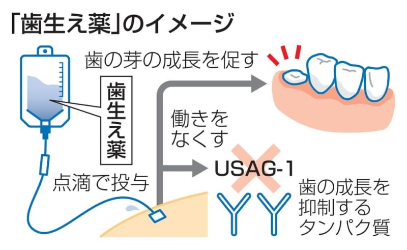 世界初の「歯生え薬」治験開始へ　子ども向け、30年実用化目指す