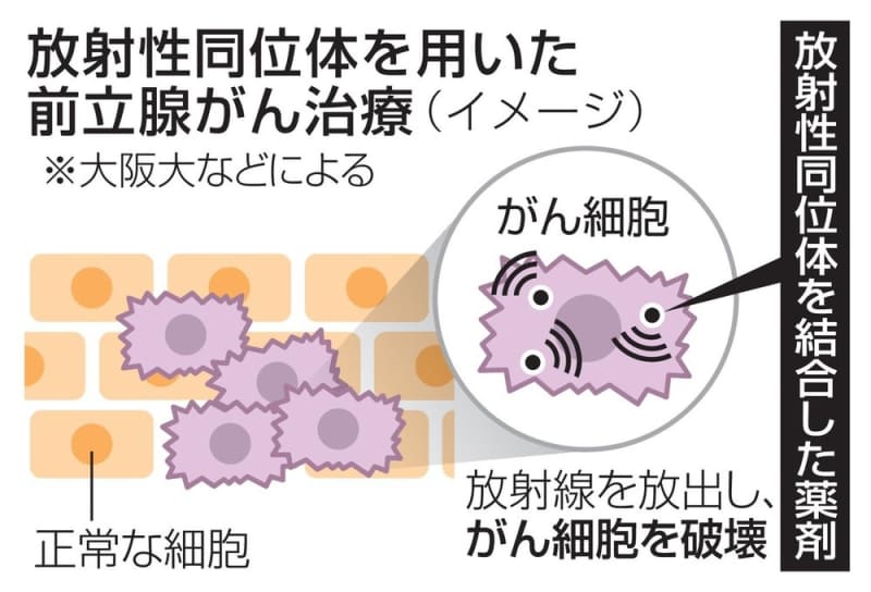前立腺がん治験開始へ、大阪大　国内製造可能な放射性同位体で