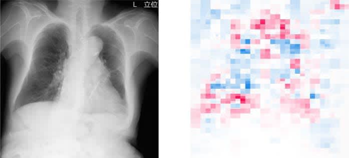 AIで画像から肺機能推定　胸部エックス線、診断活用