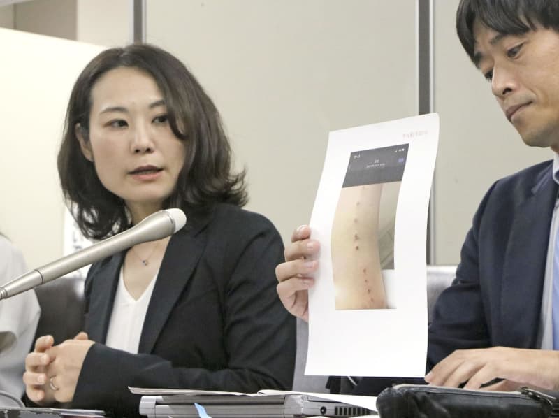 美容医療「ハイフ」で熱傷、提訴　サロン側に損賠415万円請求