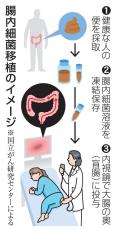 がん患者に腸内細菌移植　免疫治療への効果検証