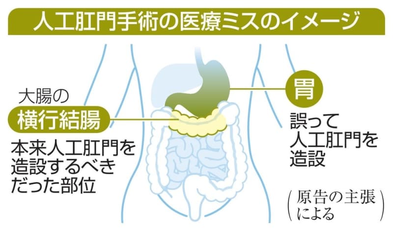 医療ミスで胃に人工肛門　病院経営の東海大を提訴