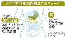 医療ミスで胃に人工肛門　病院経営の東海大を提訴