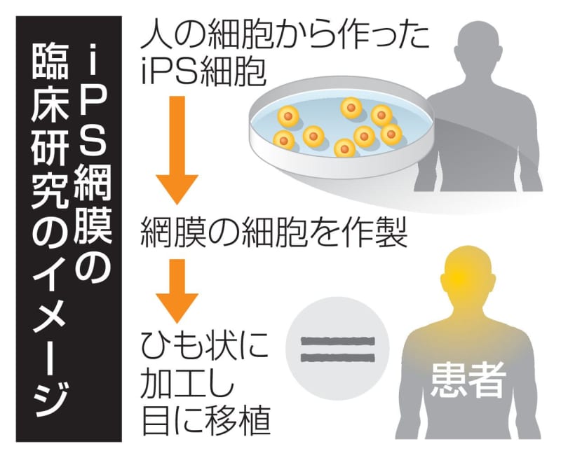 iPS網膜の移植、先進医療議論　国内初、神戸アイセンター