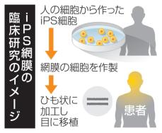 iPS網膜の移植、先進医療議論　国内初、神戸アイセンター