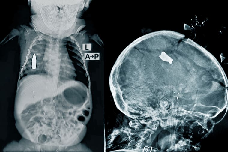 スーダン：戦傷患者の6人に1人は15歳未満の子ども──首都ハルツームの病院