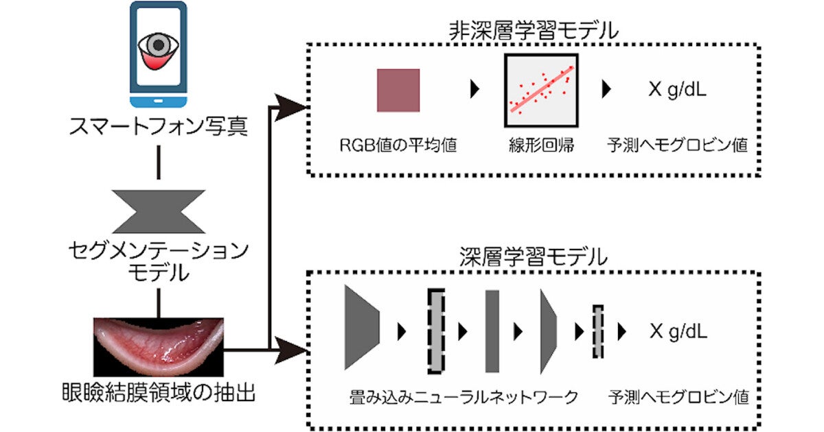 スマホカメラで撮影した眼の結膜から貧血を予測するAIを東大などが開発