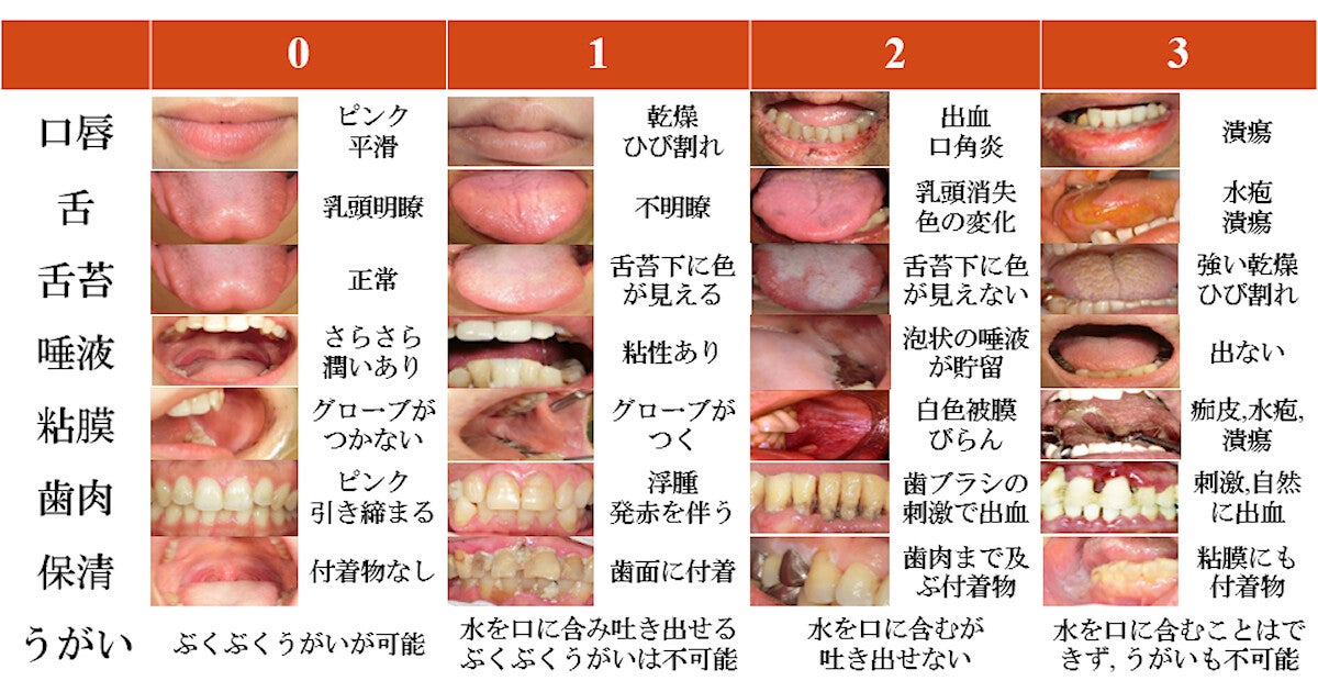 広島大、口腔状態が悪いと脳卒中患者の肺炎発症リスクが高まることを確認