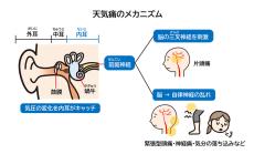 つら～い「天気痛」、その対処法は?