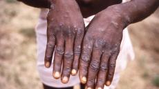 厚労省の専門部会が「天然痘ワクチン」をサル痘予防に使用するかどうか審議