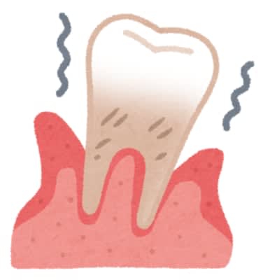 怖い歯周病… 一度消失した歯槽骨は回復せず　あなたの歯茎、大丈夫？