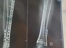 7センチの厚底サンダルを履いた女性が足をねじって粉砕骨折―中国
