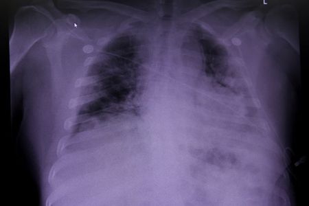 新型コロナ死者の肺に重度の損傷、症状「長期化」の原因か＝研究