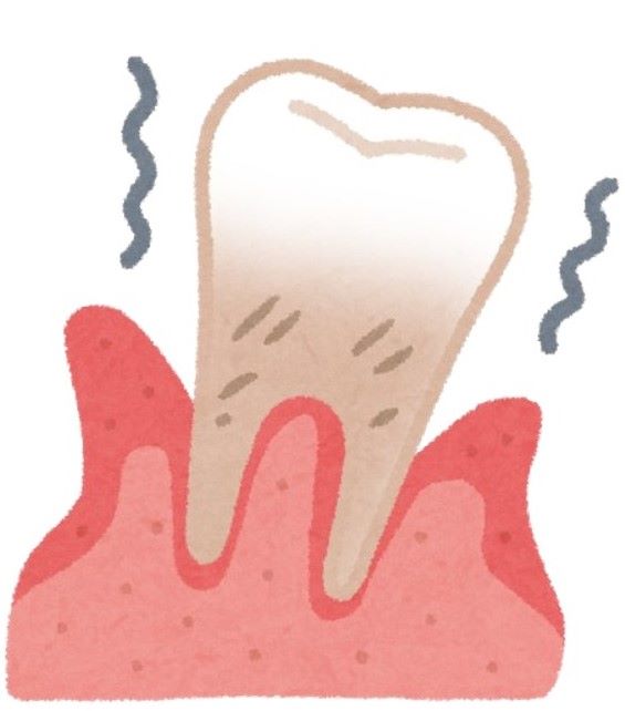歯を失う原因第一位の「歯周病」防ぐには　ロッテが発信