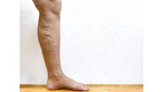 それって下肢静脈瘤かも!? 足がつる、だるい、かゆい…専門医が唱える9つのセルフチェック＆簡単だけど効果絶大の対策