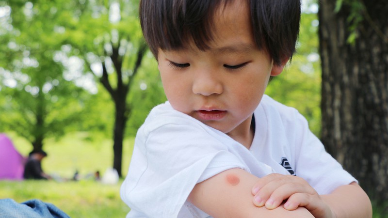 子どもは大人より腫れやすい！　虫刺されの予防＆おうちケアのコツ