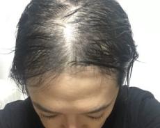 「頭髪に悩む中年男性」が絶対にやってはいけない“コスパ最悪の薄毛対策”