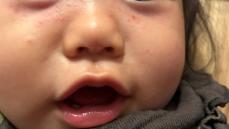 全国的に感染拡大の「手足口病」　記者が経験した１歳３か月の娘の看護　症状が改善するまでの経過は　《新潟》