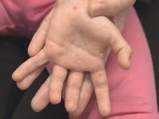 具体的な症状や発熱等は…『手足口病』とはこんな病気 飛沫や接触によって主に“5歳以下”の子供が感染