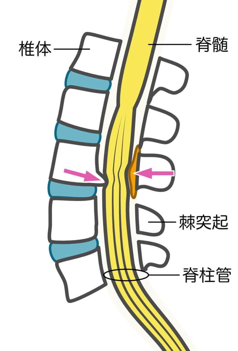 【医師のお部屋】手足のしびれ、痛みが気になるあなた、脊柱管狭窄症かもしれません…