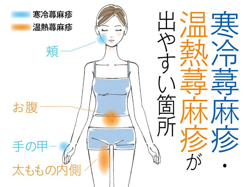 
その痒み、寒さが原因かも！？ 寒冷蕁麻疹の正体とは
        