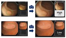NEC、内視鏡画像解析で大腸病変が腫瘍性の可能性を判定する技術を開発