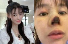 中国女優の高溜(ガオ・リュウ)、鼻整形後に”壊死”…写真公開し韓国でも話題に