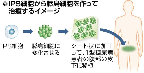 重症の糖尿病患者にｉＰＳ細胞による膵島細胞シート移植、京大病院が治験へ…来年１月に患者登録開始