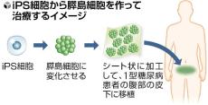 重症の糖尿病患者にｉＰＳ細胞による膵島細胞シート移植、京大病院が治験へ…来年１月に患者登録開始